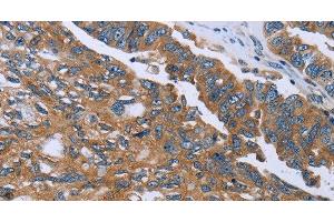 Immunohistochemistry of paraffin-embedded Human ovarian cancer using GAB2 Polyclonal Antibody at dilution of 1:40 (GAB2 antibody)