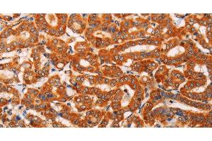 Immunohistochemistry of paraffin-embedded Human thyroid cancer using SLC25A4 Polyclonal Antibody at dilution of 1:40 (SLC25A4 antibody)
