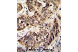 STK32A Antibody (N-term) (ABIN655889 and ABIN2845288) immunohistochemistry analysis in formalin fixed and paraffin embedded human bladder carcinoma followed by peroxidase conjugation of the secondary antibody and DAB staining.