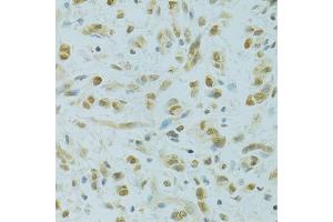Immunohistochemistry of paraffin-embedded human gastric cancer using RCC1 antibody (ABIN5973761) at dilution of 1/100 (40x lens). (RCC1 antibody)