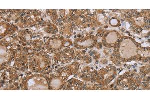 Immunohistochemistry of paraffin-embedded Human thyroid cancer using NDUFS2 Polyclonal Antibody at dilution of 1:35