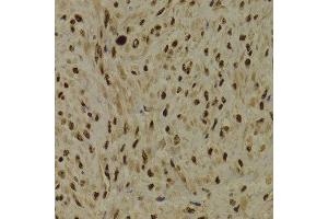 Immunohistochemistry of paraffin-embedded Human adenomyosis using PPP1R8 antibody at dilution of 1:100 (x400 lens).