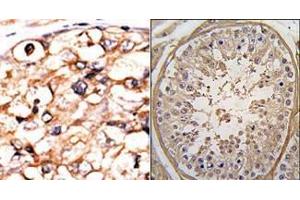 (LEFT)Formalin-fixed and paraffin-embedded human cancer tissue reacted with the primary antibody, which was peroxidase-conjugated to the secondary antibody, followed by AEC staining. (PGK2 antibody  (N-Term))