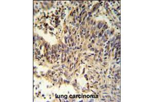 RXRA Antibody IHC analysis in formalin fixed and paraffin embedded lung carcinoma followed by peroxidase conjugation of the secondary antibody and DAB staining.