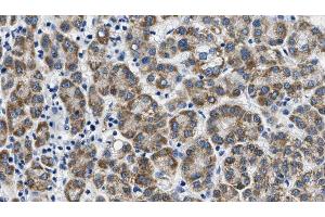 ABIN6268790 at 1/100 staining Human liver cancer tissue by IHC-P. (FSHR antibody  (Internal Region))