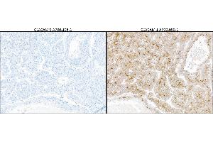 Immunohistochemistry (IHC) image for anti-Carcinoembryonic Antigen-Related Cell Adhesion Molecule 5 (CEACAM5) (AA 35-685) antibody (ABIN7453964) (Recombinant CEACAM5 antibody  (AA 35-685))