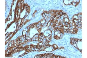 Formalin-fixed, paraffin-embedded human Colon Carcinoma stained with TACSTD2 / TROP2 Mouse Monoclonal Antibody (TACSTD2/2152). (TACSTD2 antibody  (AA 31-274))