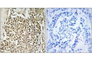 Immunohistochemistry analysis of paraffin-embedded human breast carcinoma, using CEP350 Antibody. (CEP350 antibody  (AA 671-720))