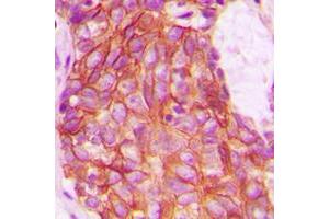 Immunohistochemical analysis of GPR159 staining in human breast cancer formalin fixed paraffin embedded tissue section. (CXCR7 antibody  (C-Term))