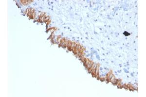 Formalin-fixed, paraffin-embedded human Bladder Carcinoma stained with MAML2 Monoclonal Antibody (MAML2/1302). (MAML2 antibody)