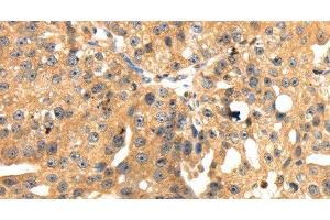 Immunohistochemistry of paraffin-embedded Human breast cancer tissue using SH3KBP1 Polyclonal Antibody at dilution 1:45 (SH3KBP1 antibody)