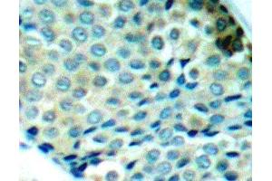Immunohistochemistry of paraffin-embedded Human breast carcinoma using Phospho-HSPB1(S78) Polyclonal Antibody (HSP27 antibody  (pSer78))