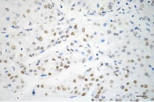 Immunohistochemistry was performed on paraffin-embedded human hepatocarcinoma using a-kinase anchoring protein 8 antibody (ABIN7797434), 1:200).