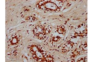 IHC image of ABIN7166751 diluted at 1:300 and staining in paraffin-embedded human breast cancer performed on a Leica BondTM system. (POU5F1B antibody  (AA 10-138))