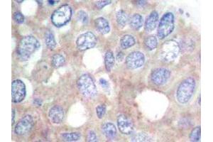 Immunohistochemistry analyzes of p70 S6K antibody in paraffin-embedded human breast carcinoma tissue. (RPS6KB1 antibody)