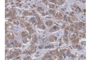 DAB staining on IHC-P; Samples: Human Breast cancer Tissue (GBP4 antibody  (AA 1-292))