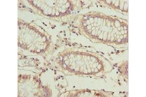 Immunohistochemistry of paraffin-embedded human colon cancer using ABIN7164553 at dilution of 1:100 (LARS2 antibody  (AA 1-250))