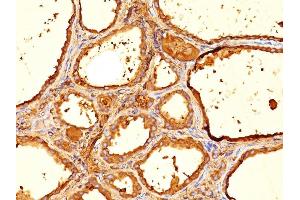 Formalin-fixed, paraffin-embedded human Thyroid stained with Thyroglobulin Mouse Monoclonal Antibody (6E1). (Thyroglobulin antibody)