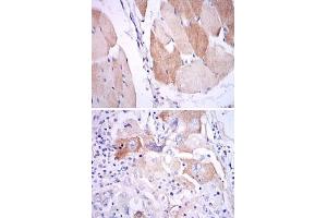Immunohistochemical analysis of paraffin-embedded human muscle (upper) and human lung cancer (bottom) tissues using IL1B monoclonal antibody, clone 3A6  with DAB staining. (IL-1 beta antibody)