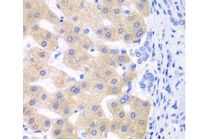 Immunohistochemistry of paraffin-embedded Human liver cancer using CYP2C18 Polyclonal Antibody at dilution of 1:100 (40x lens).