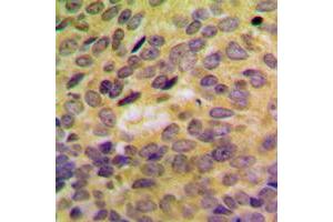 Immunohistochemical analysis of SH3GLB2 staining in human breast cancer formalin fixed paraffin embedded tissue section. (SH3GLB2 antibody  (Center))