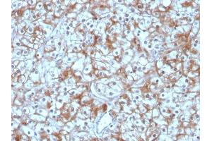 Formalin-fixed, paraffin-embedded human Bladder Carcinoma stained with Calpastatin Mouse Monoclonal Antibody (CAST/1550). (Calpastatin antibody)