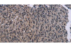 Immunohistochemistry of paraffin-embedded Human lung cancer using KDM4D Polyclonal Antibody at dilution of 1:50 (JMJD2D antibody)