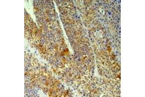 Immunohistochemical analysis of Cyclophilin B staining in human heptacancer,human pancreatic cancer formalin fixed paraffin embedded tissue section. (PPIB antibody)