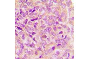 Immunohistochemical analysis of GRP78 staining in human breast cancer formalin fixed paraffin embedded tissue section.