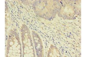 Immunohistochemistry of paraffin-embedded human colon cancer using ABIN7172114 at dilution of 1:100 (TK1 antibody  (AA 2-234))