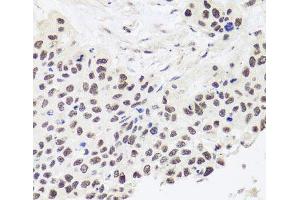 Immunohistochemistry of paraffin-embedded Human lung cancer using RPP30 Polyclonal Antibody at dilution of 1:100 (40x lens).