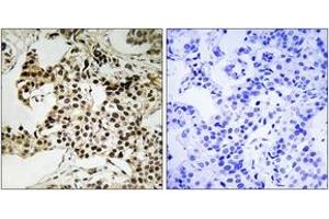 Immunohistochemistry analysis of paraffin-embedded human breast carcinoma, using PKR (Phospho-Thr258) Antibody. (EIF2AK2 antibody  (pThr258))