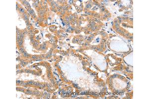 Immunohistochemistry of Human thyroid cancer using ACOT11 Polyclonal Antibody at dilution of 1:25 (ACOT11 antibody)