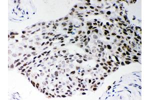 Anti- SF2 Picoband antibody, IHC(P) IHC(P): Human Mammary Cancer Tissue (SRSF1 antibody  (N-Term))