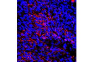Immunofluorescence of paraffin embedded human ovarian cancer using TFIIIC110 (ABIN7074038) at dilution of 1:650 (400x lens) (GTF3C2 antibody)