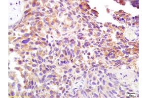 Formalin-fixed and paraffin embedded human bladder carcinoma labeled with Rabbit Anti CD138/Syndecan-1 Polyclonal Antibody, Unconjugated (ABIN674769) at 1:200 followed by conjugation to the secondary antibody and DAB staining
