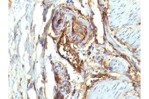 Formalin-fixed, paraffin-embedded human colon carcinoma stained with CD34 antibody (QBEnd/10 + HPCA1/763) (CD34 antibody)
