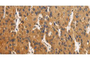 Immunohistochemistry of paraffin-embedded Human liver cancer using CALU Polyclonal Antibody at dilution of 1:40 (CALU antibody)