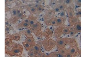 Detection of CK4 in Human Liver cancer Tissue using Polyclonal Antibody to Cytokeratin 4 (CK4) (KRT4 antibody  (AA 152-457))