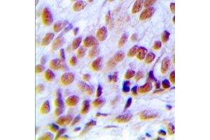 Immunohistochemical analysis of hNRNP C (pS260) staining in human breast cancer formalin fixed paraffin embedded tissue section. (HNRNPC antibody  (C-Term, pSer260))