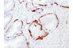 Formalin-fixed, paraffin-embedded human Prostate Carcinoma stained with Cytokeratin 14 Mouse Monoclonal Antibody (LL002). (KRT14 antibody  (C-Term))