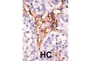 Formalin-fixed and paraffin-embedded human hepatocellular carcinoma tissue reacted with the APOBEC3G polyclonal antibody  , which was peroxidase-conjugated to the secondary antibody, followed by AEC staining. (APOBEC3G antibody  (Internal Region))