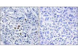 Immunohistochemistry analysis of paraffin-embedded human breast carcinoma, using PLK1 (Phospho-Thr210) Antibody. (PLK1 antibody  (pThr210))