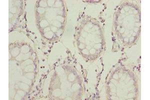 Immunohistochemistry of paraffin-embedded human colon cancer using ABIN7143865 at dilution of 1:100 (ENO1 antibody  (AA 2-428))