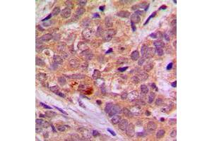 Immunohistochemical analysis of LKB1 staining in human breast cancer formalin fixed paraffin embedded tissue section. (LKB1 antibody  (C-Term))