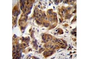 ZGRF1 antibody immunohistochemistry analysis in formalin fixed and paraffin embedded human bladder carcinoma. (ZGRF1 antibody  (AA 38-66))