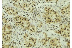 ABIN6267117 at 1/100 staining Human breast cancer tissue by IHC-P. (FOXO3 antibody  (pSer413))