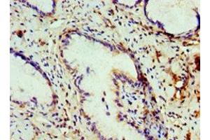 Immunohistochemistry of paraffin-embedded human cervical cancer using ABIN7148465 at dilution of 1:100 (COG7 antibody  (AA 511-770))