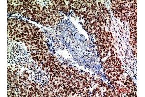 Immunohistochemical analysis of paraffin-embedded human-breast-cancer, antibody was diluted at 1:200 (ACER2 antibody  (Internal Region))