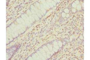 Immunohistochemistry of paraffin-embedded human colon cancer using ABIN7165941 at dilution of 1:100 (PPM1A antibody  (AA 1-382))